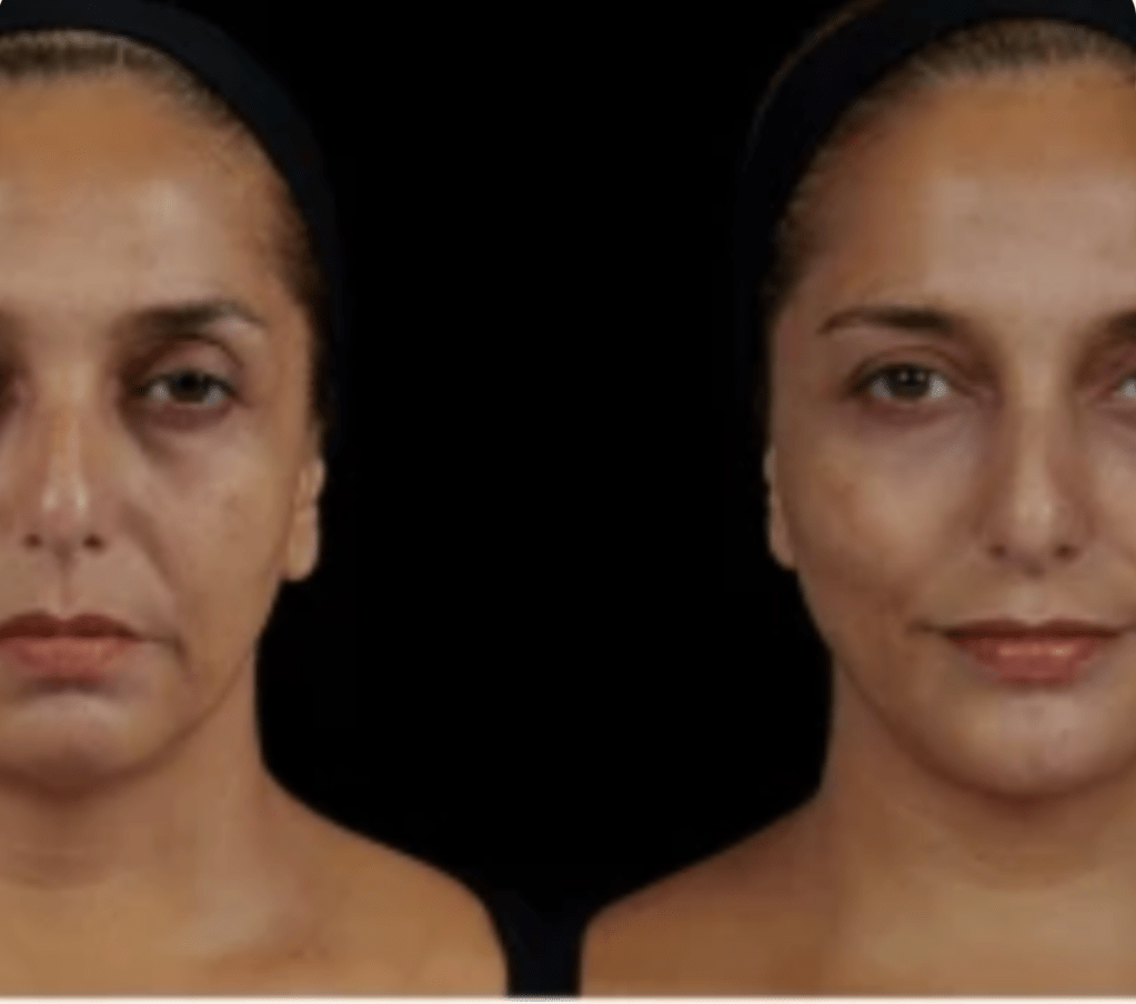 Effective Hyaluronic Acid Filler&nbsp;Techniques