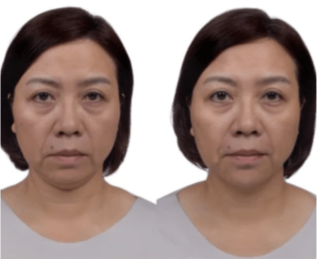 Transform Your Look: Before and After Hyaluronic Acid&nbsp;Fillers