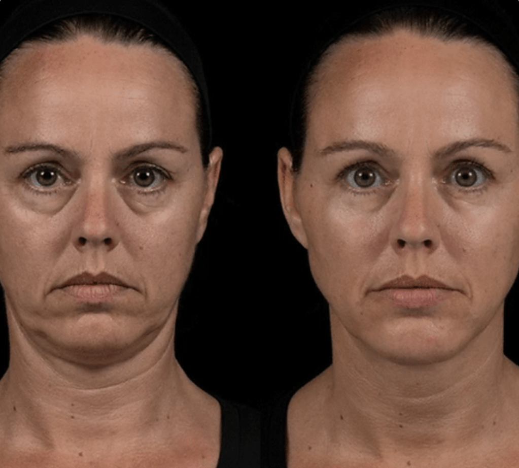 Transformative filler Results for Facial&nbsp;Rejuvenation